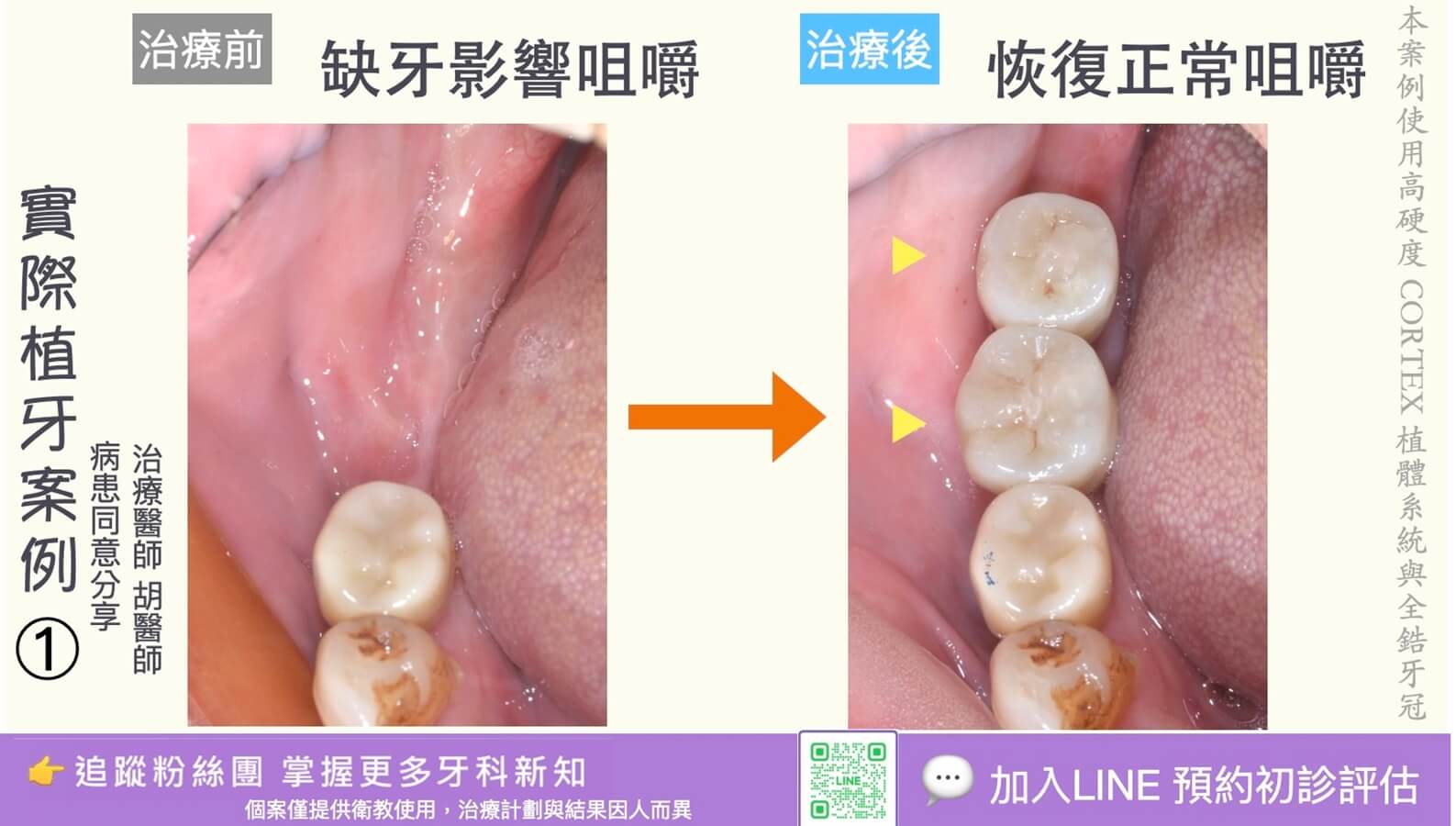 人工植牙治療實際案例成果01