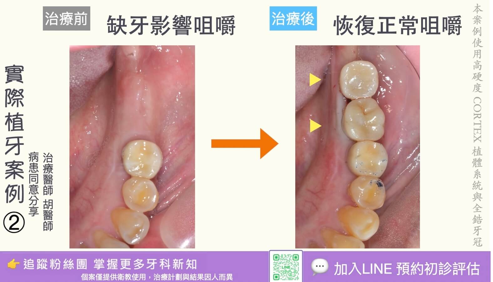 人工植牙治療實際案例成果02