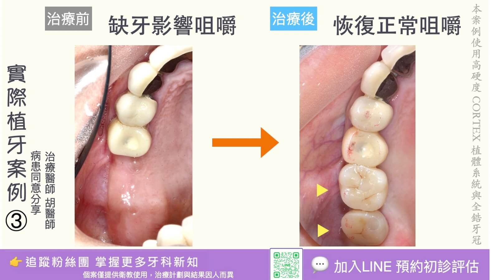 人工植牙治療實際案例成果03