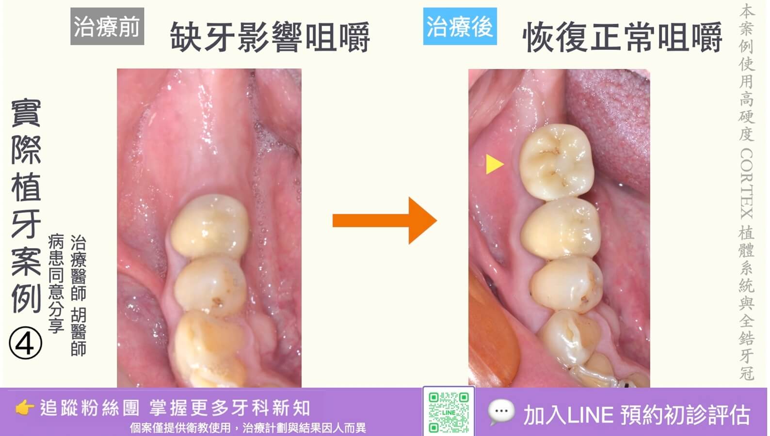 人工植牙治療實際案例成果04