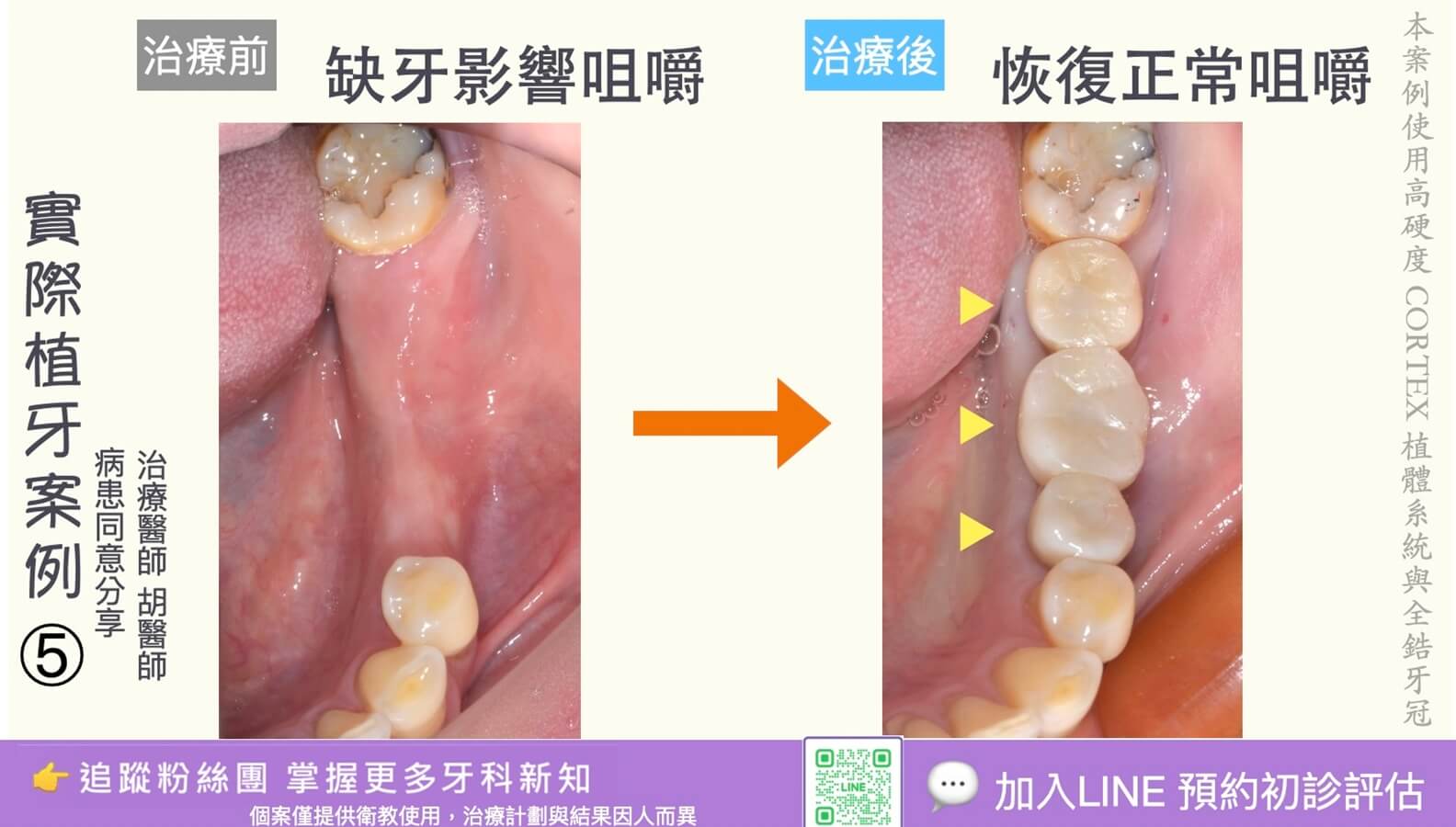人工植牙治療實際案例成果05