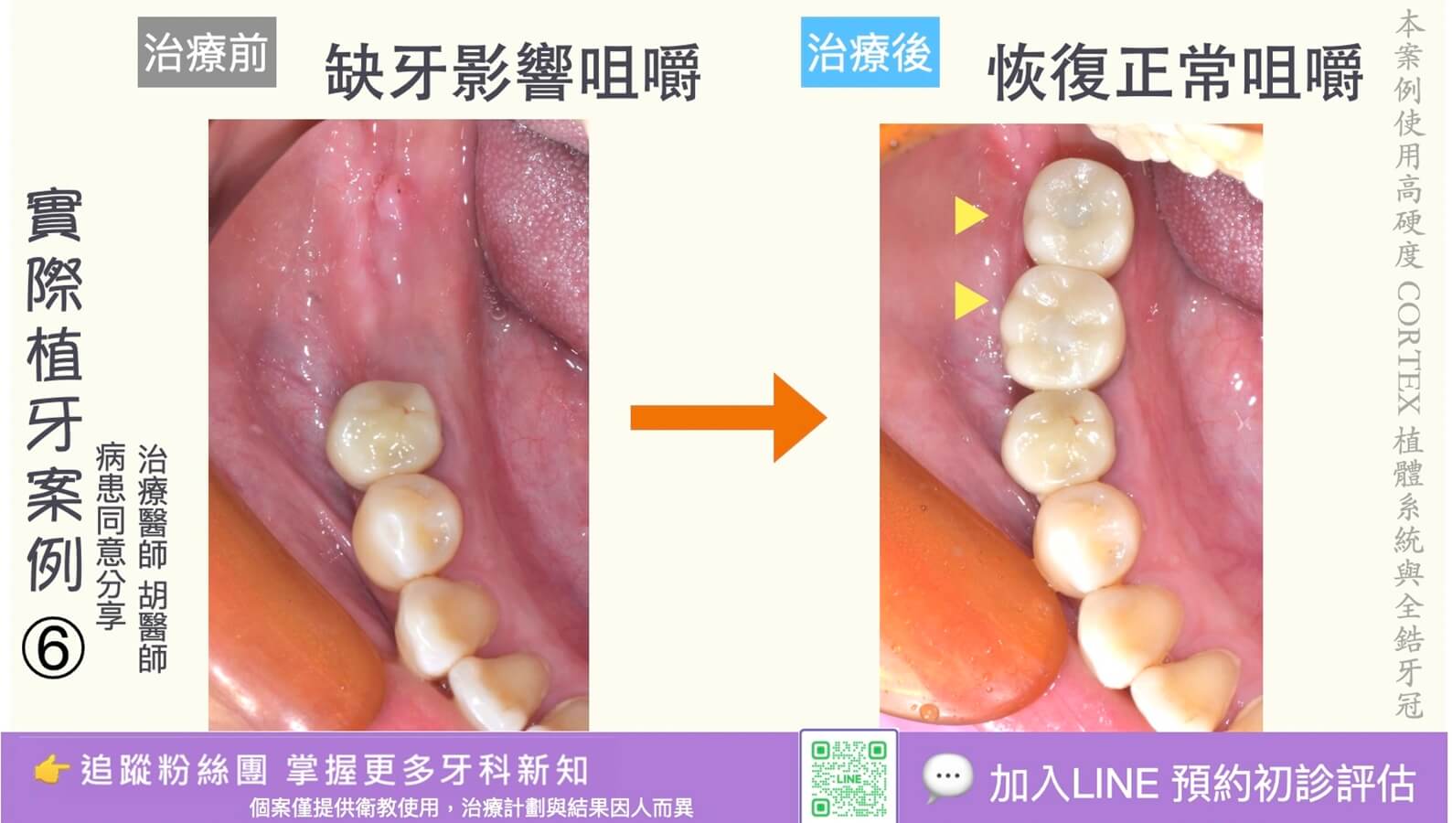 人工植牙治療實際案例成果06