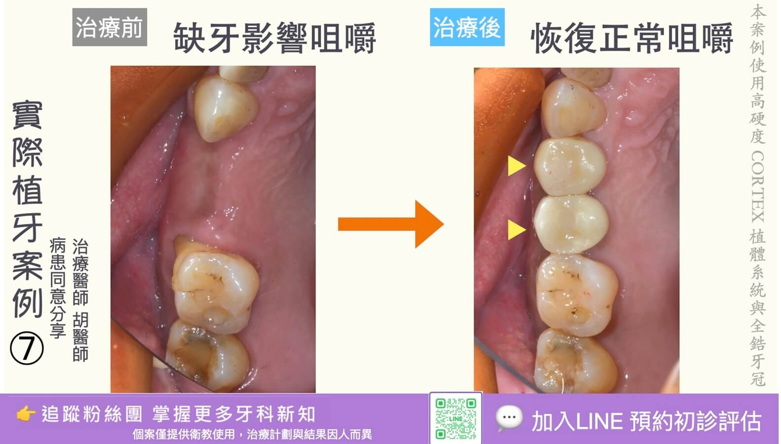 人工植牙治療實際案例成果07