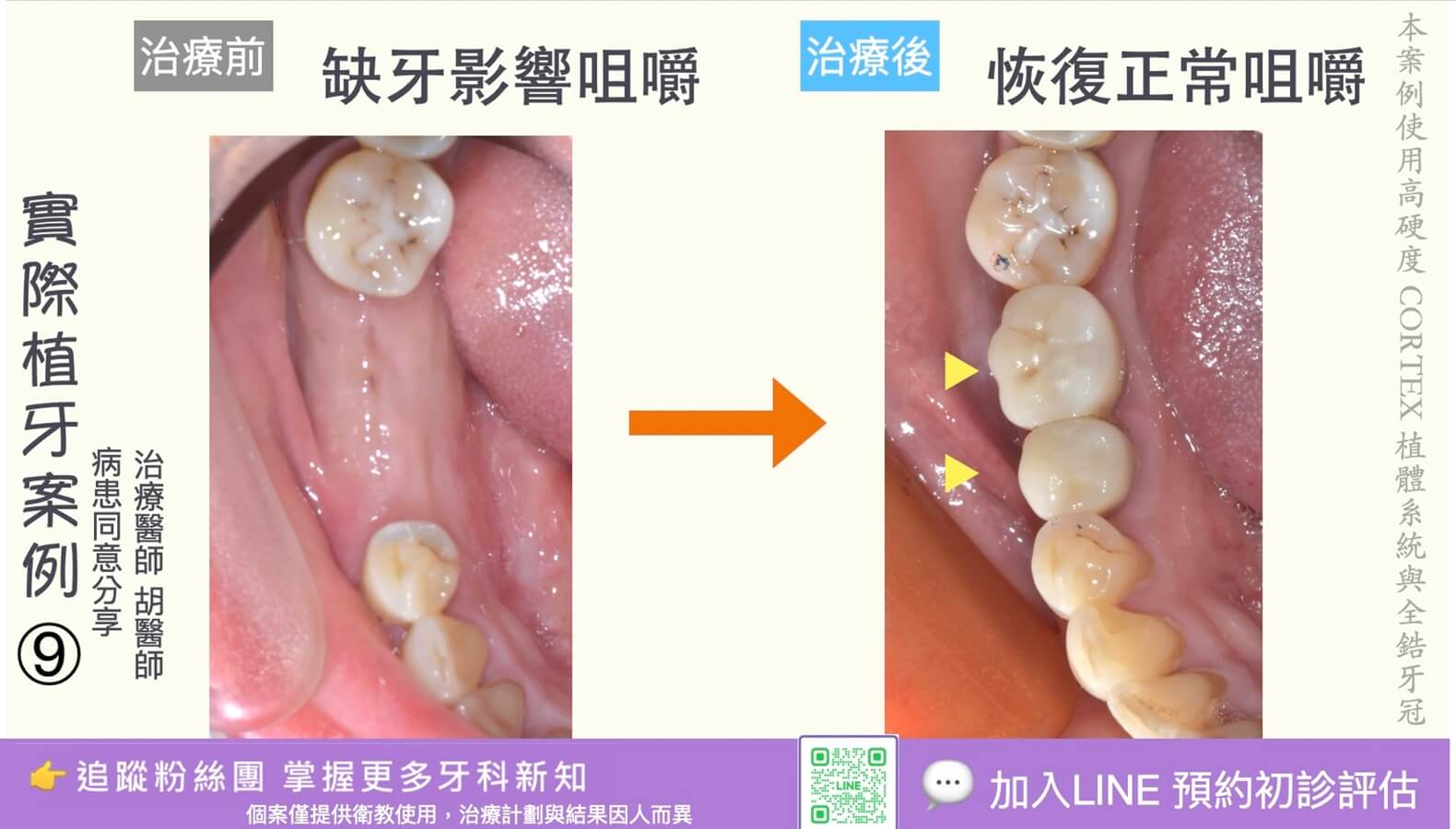 人工植牙治療實際案例成果09