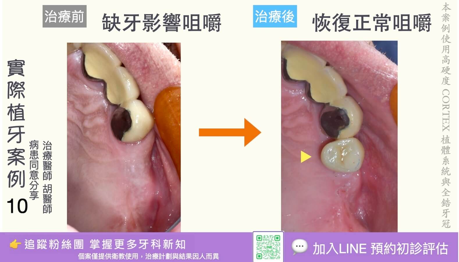 人工植牙治療實際案例成果10