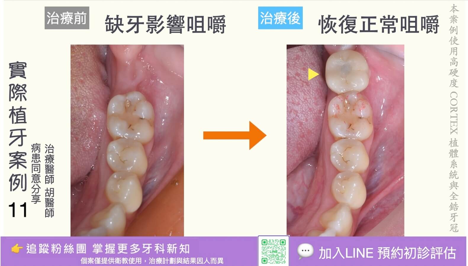 人工植牙治療實際案例成果11