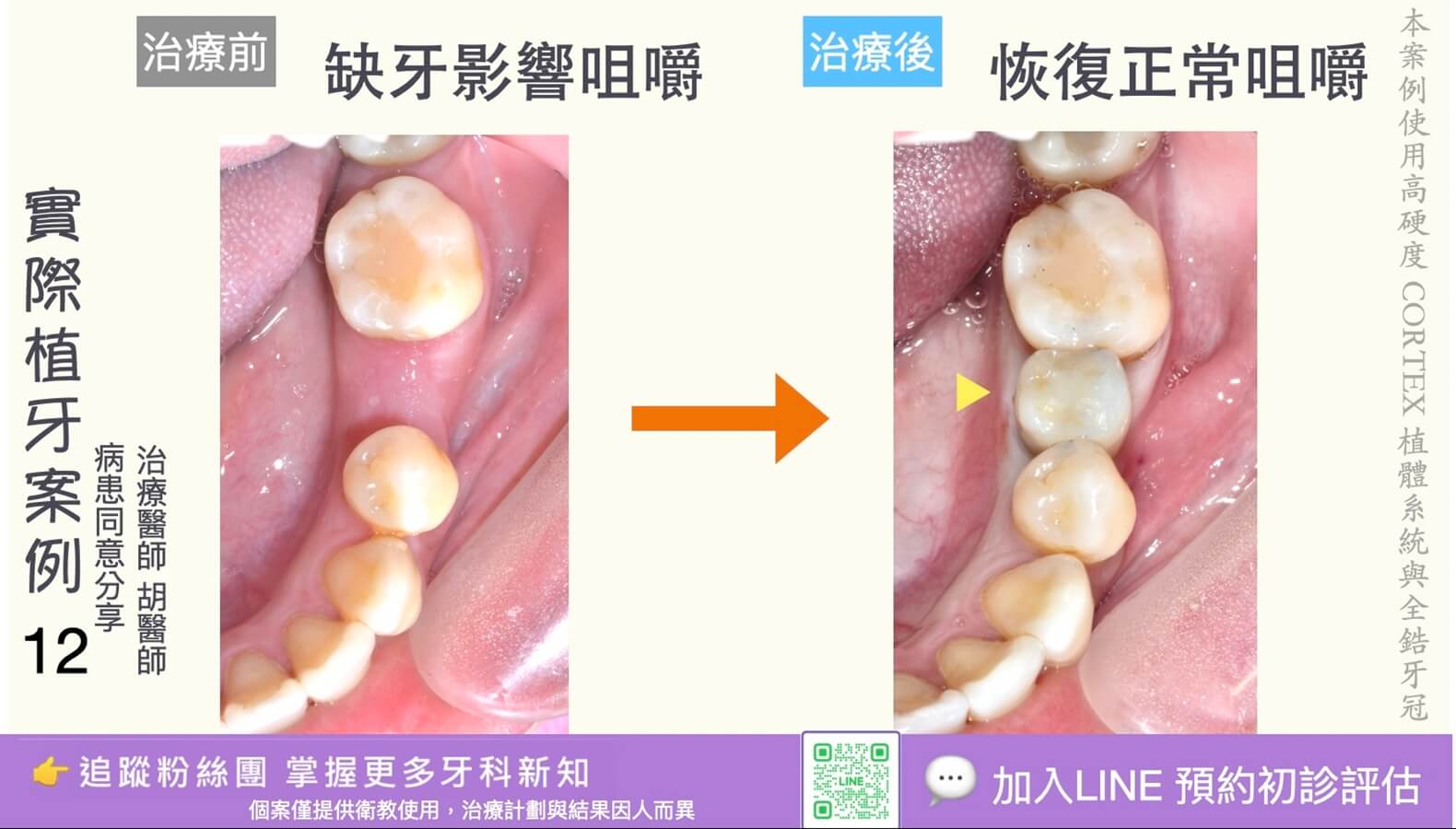 人工植牙治療實際案例成果12