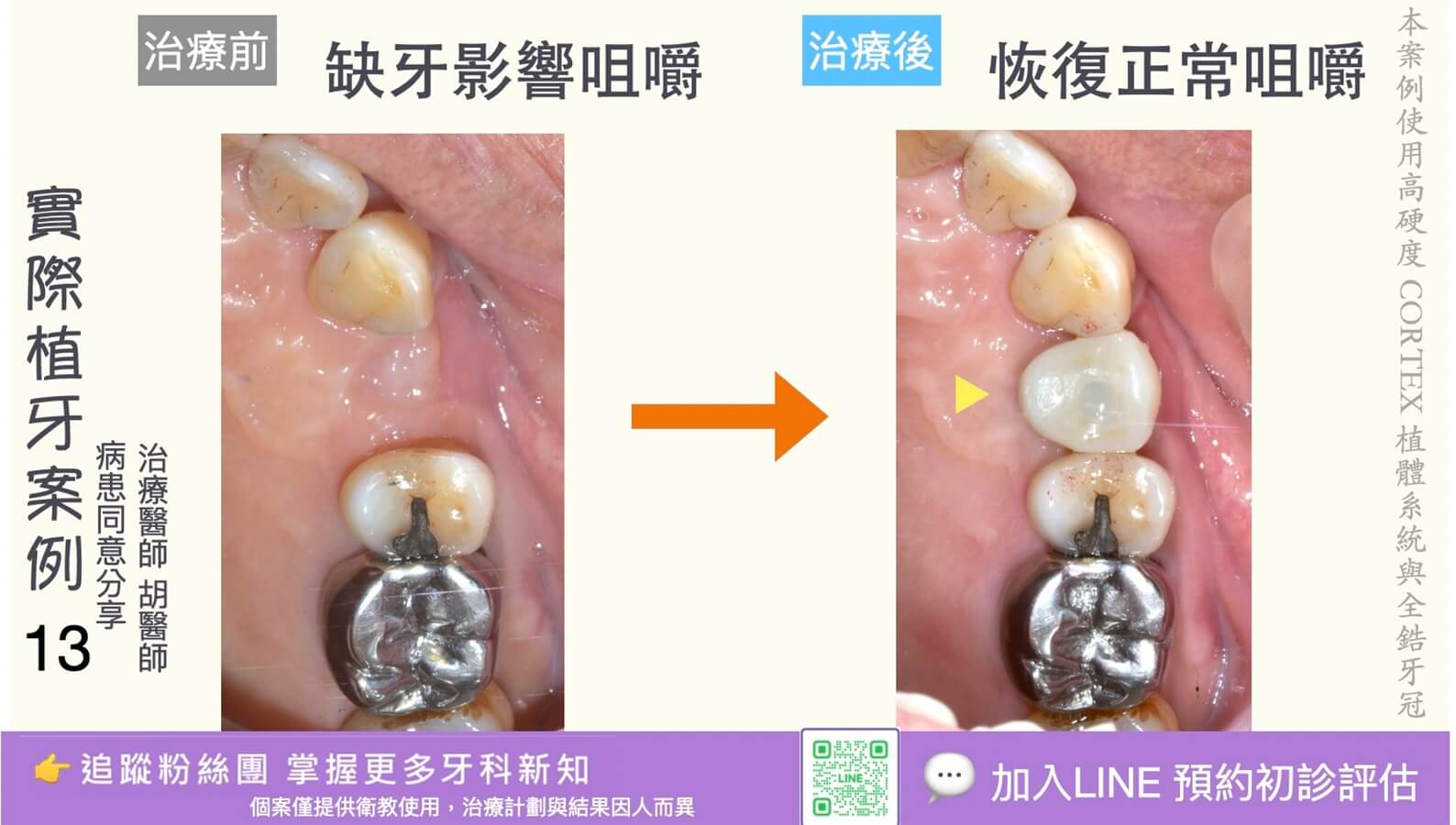 人工植牙治療實際案例成果13