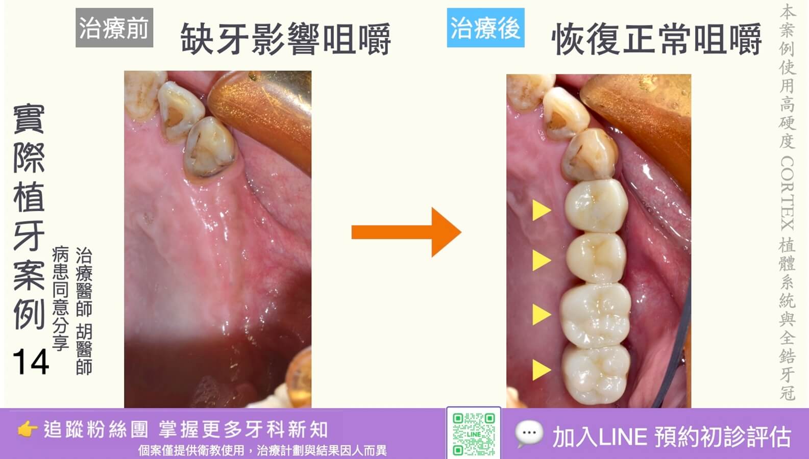 人工植牙治療實際案例成果14