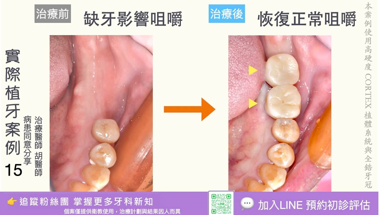 人工植牙治療實際案例成果15