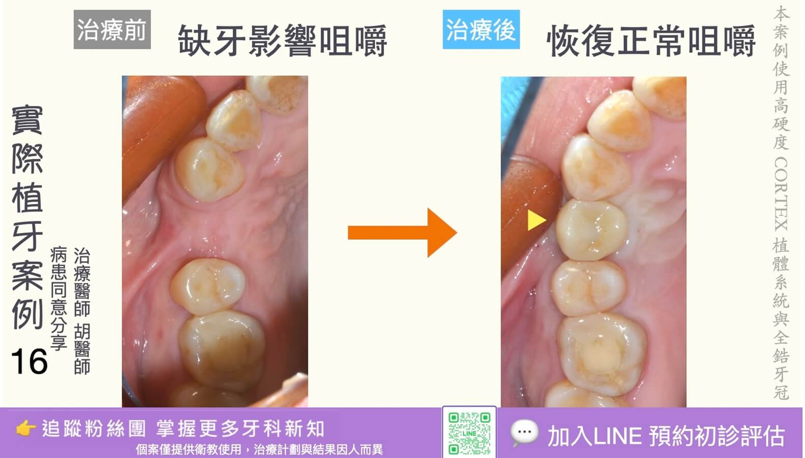 人工植牙治療實際案例成果16