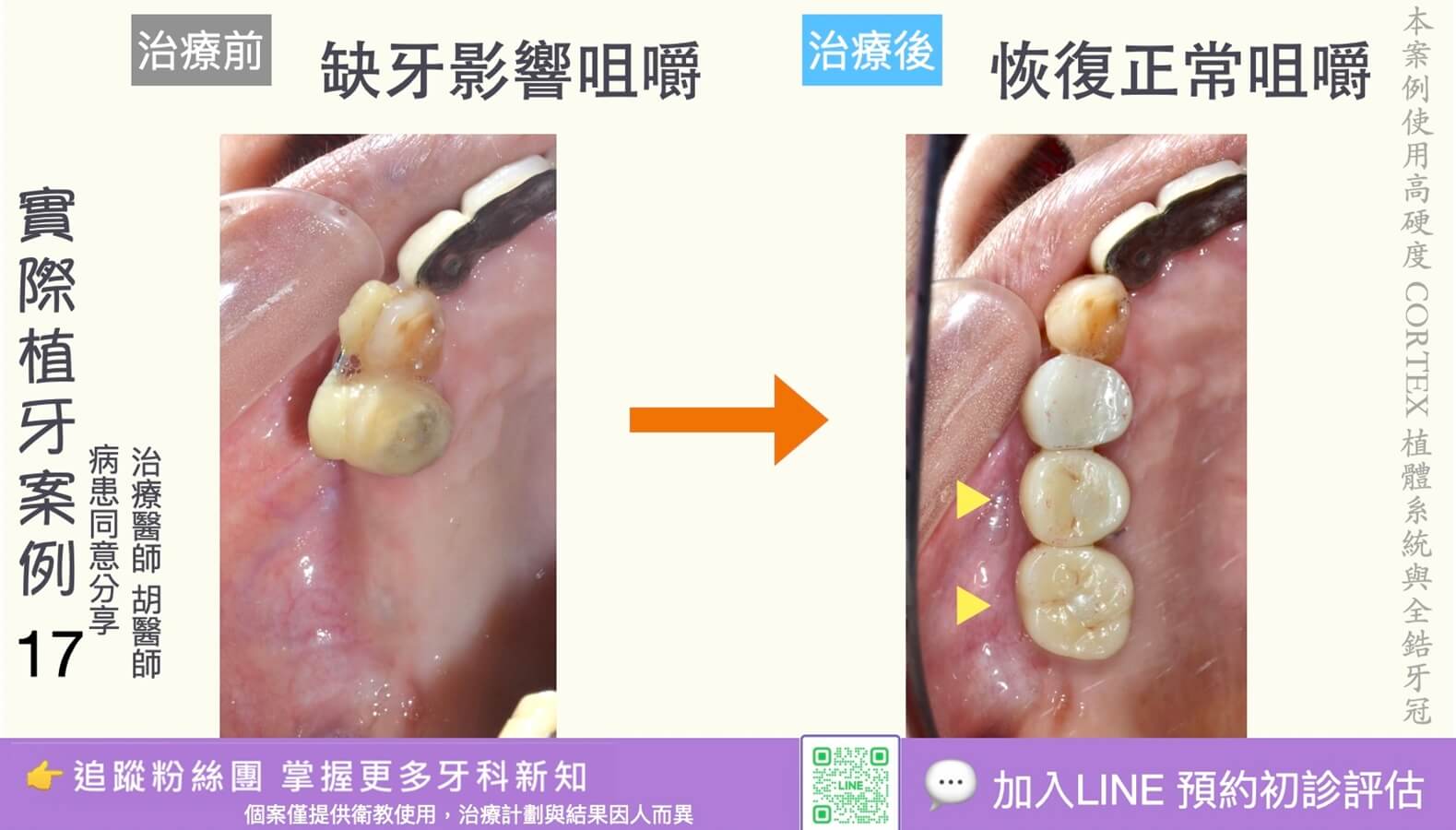 人工植牙治療實際案例成果17