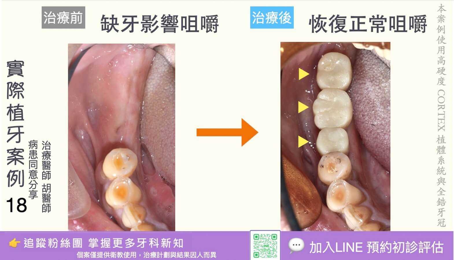 人工植牙治療實際案例成果18