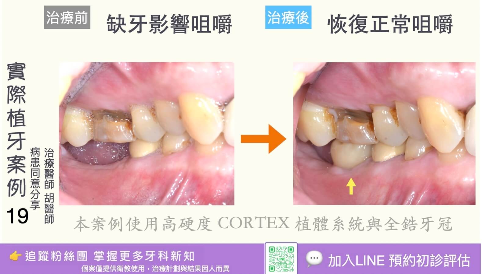 人工植牙治療實際案例成果19