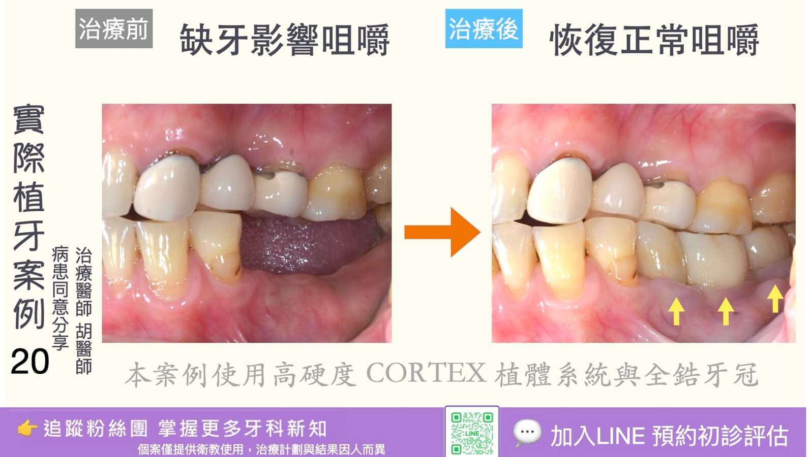 人工植牙治療實際案例成果20