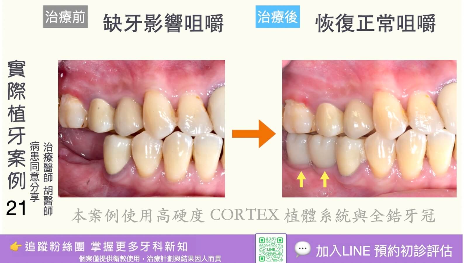 人工植牙治療實際案例成果21