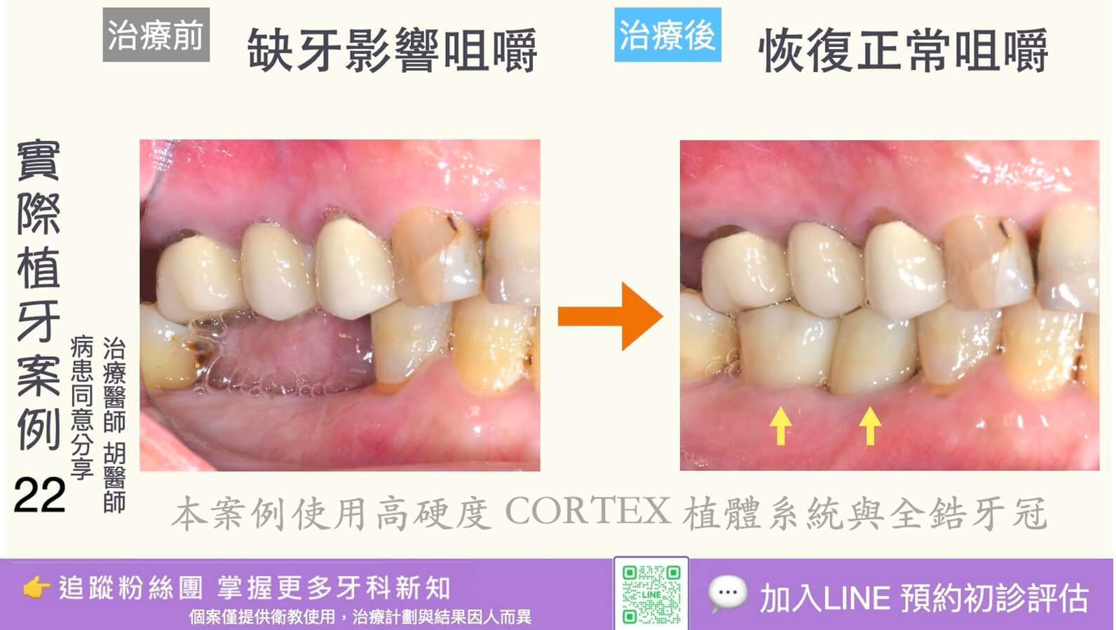 人工植牙治療實際案例成果22
