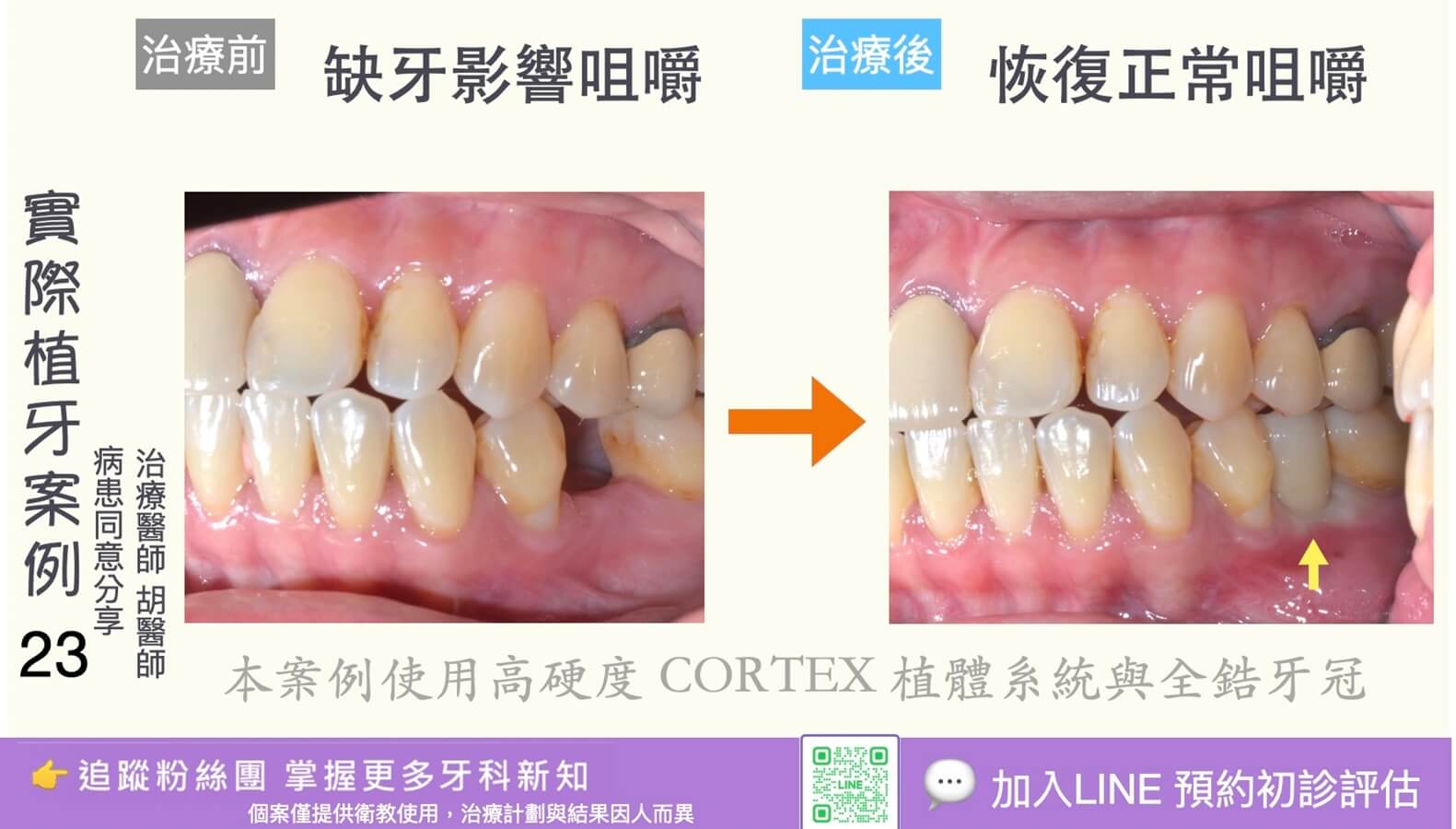 人工植牙治療實際案例成果23