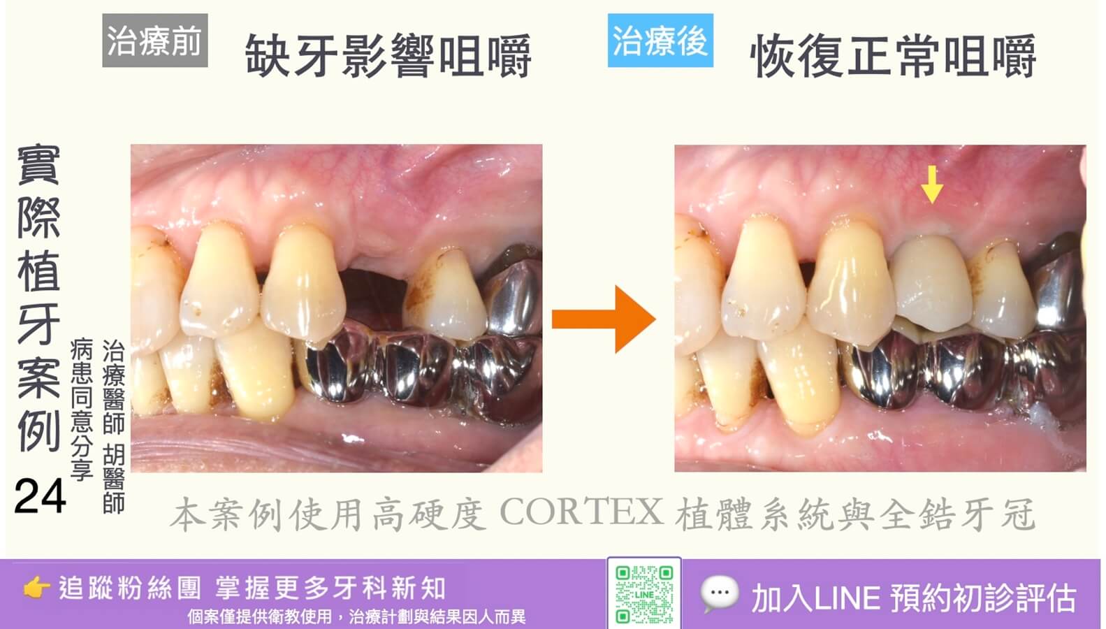 人工植牙治療實際案例成果24