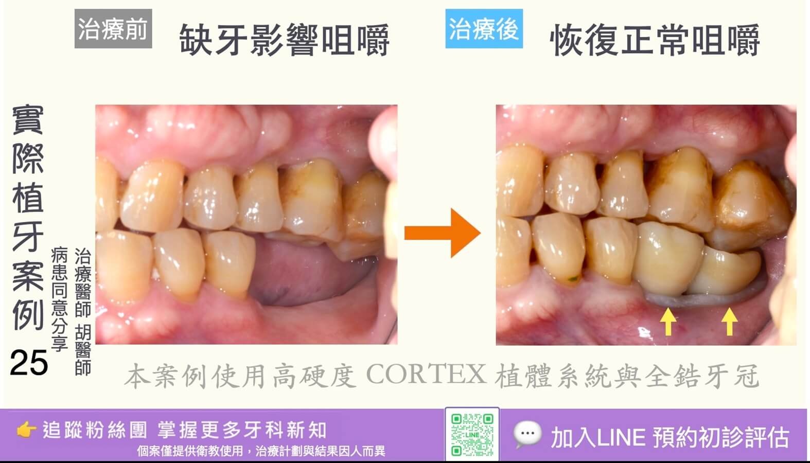 人工植牙治療實際案例成果25