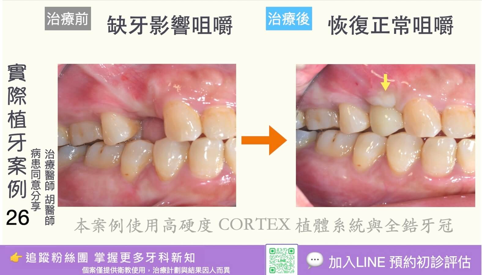人工植牙治療實際案例成果26