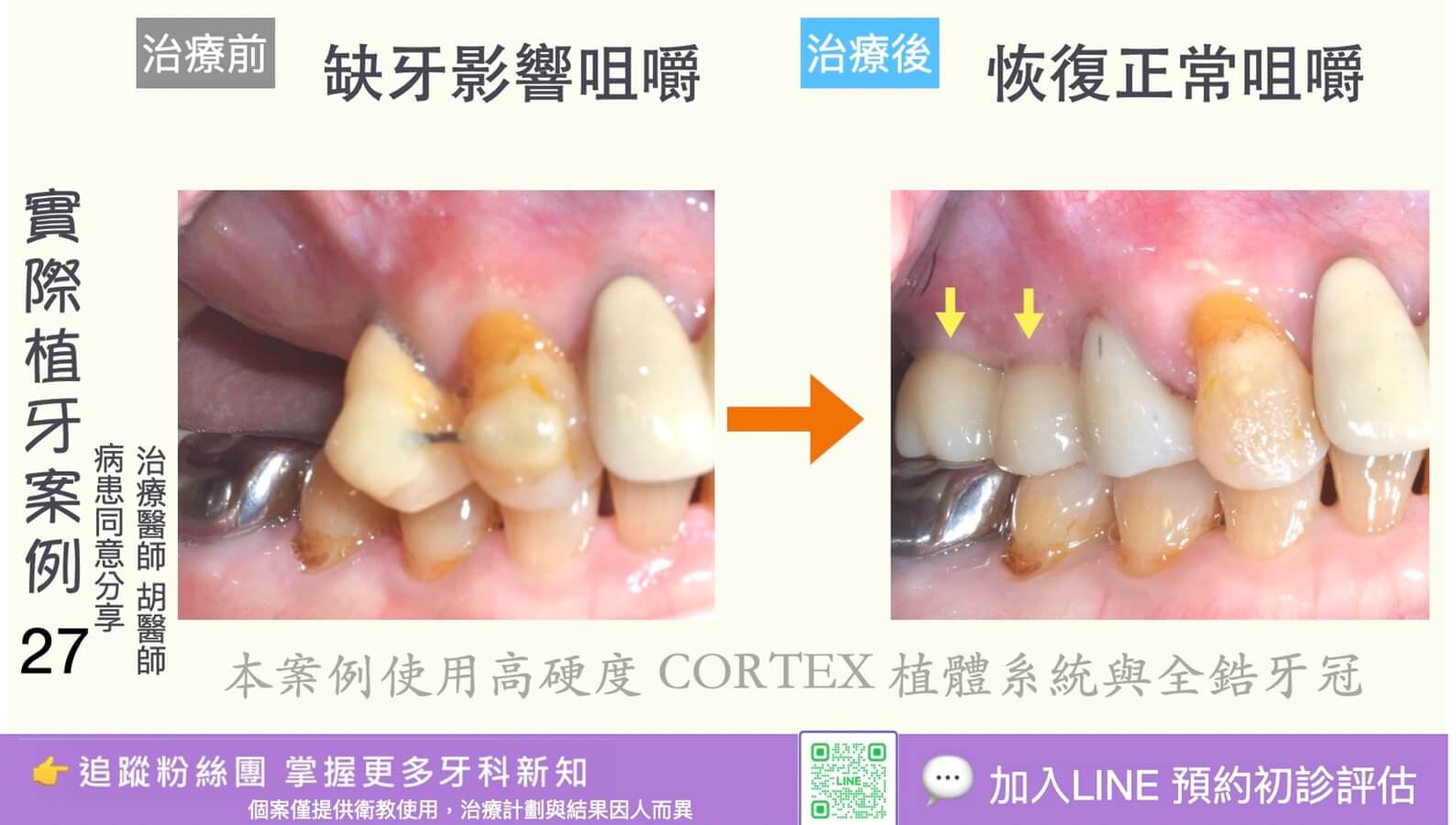 人工植牙治療實際案例成果27