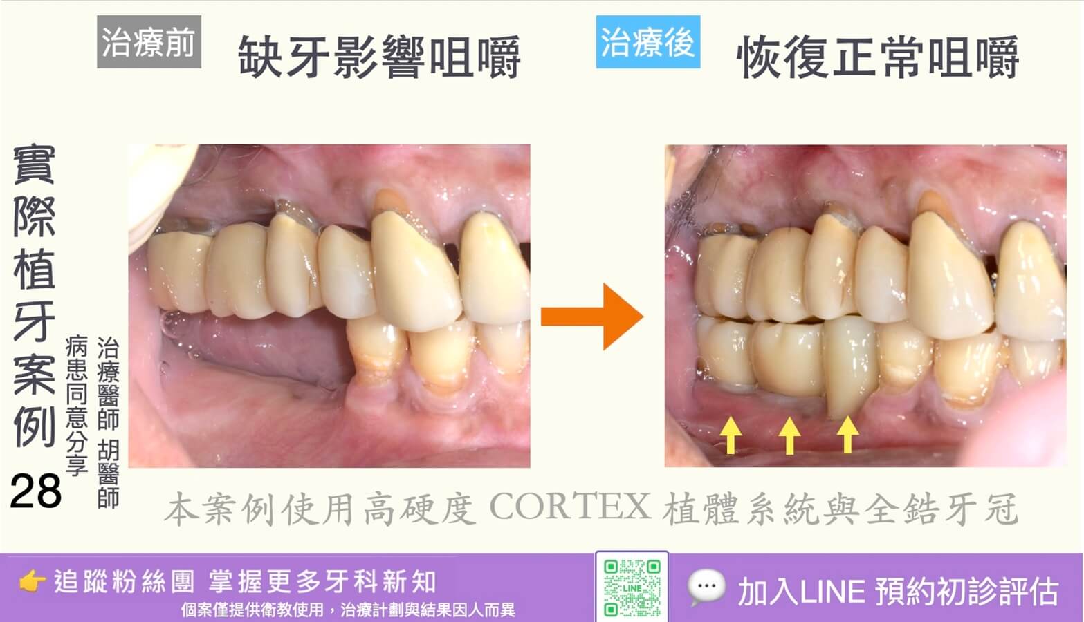 人工植牙治療實際案例成果28