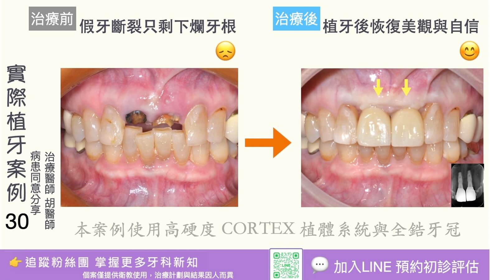 人工植牙治療實際案例成果30