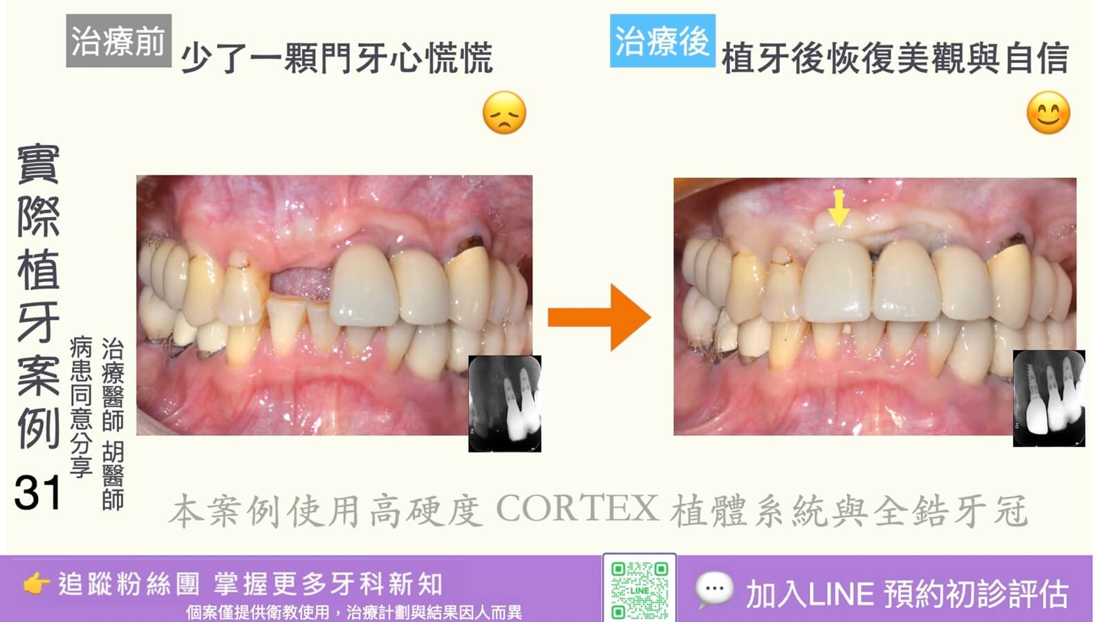 人工植牙治療實際案例成果31