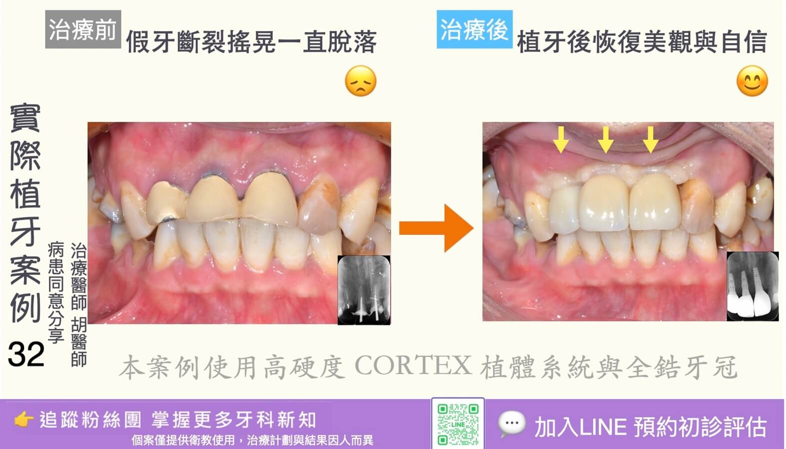 人工植牙治療實際案例成果32