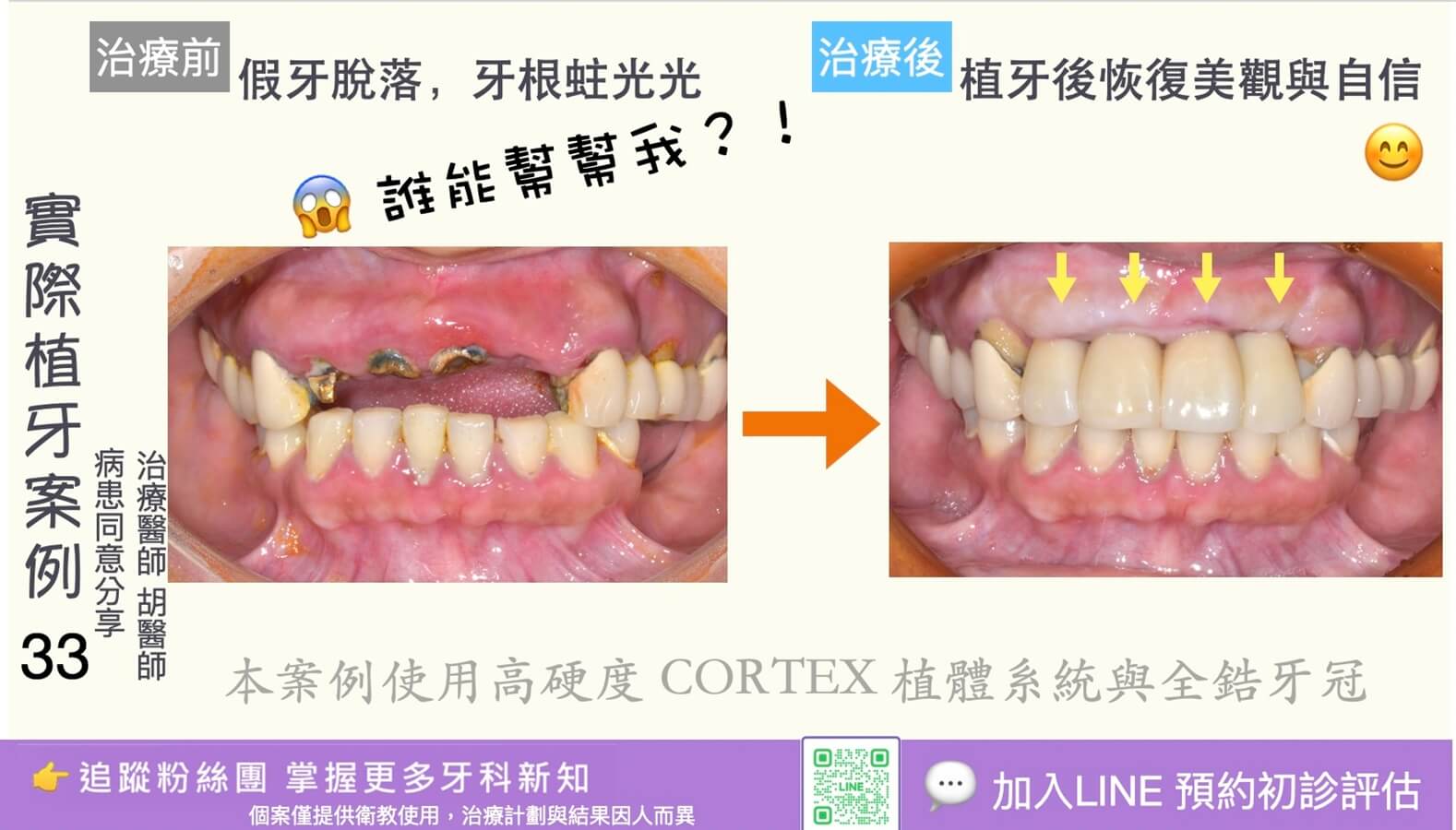 人工植牙治療實際案例成果33
