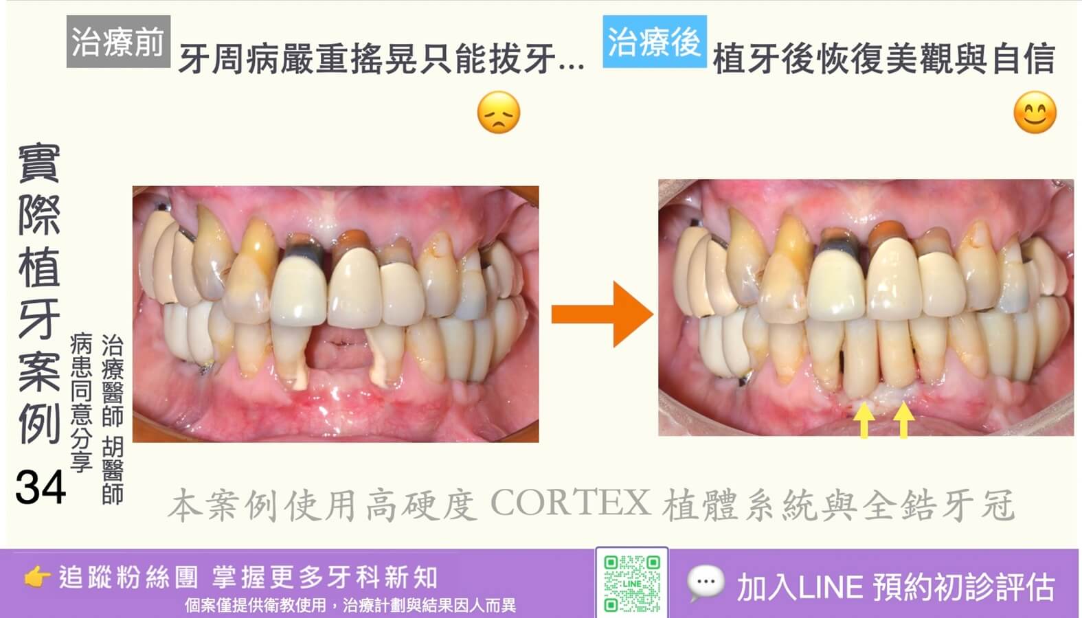 人工植牙治療實際案例成果34