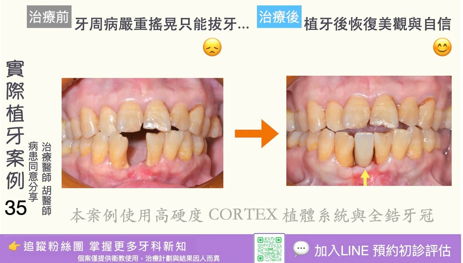 人工植牙治療實際案例成果35