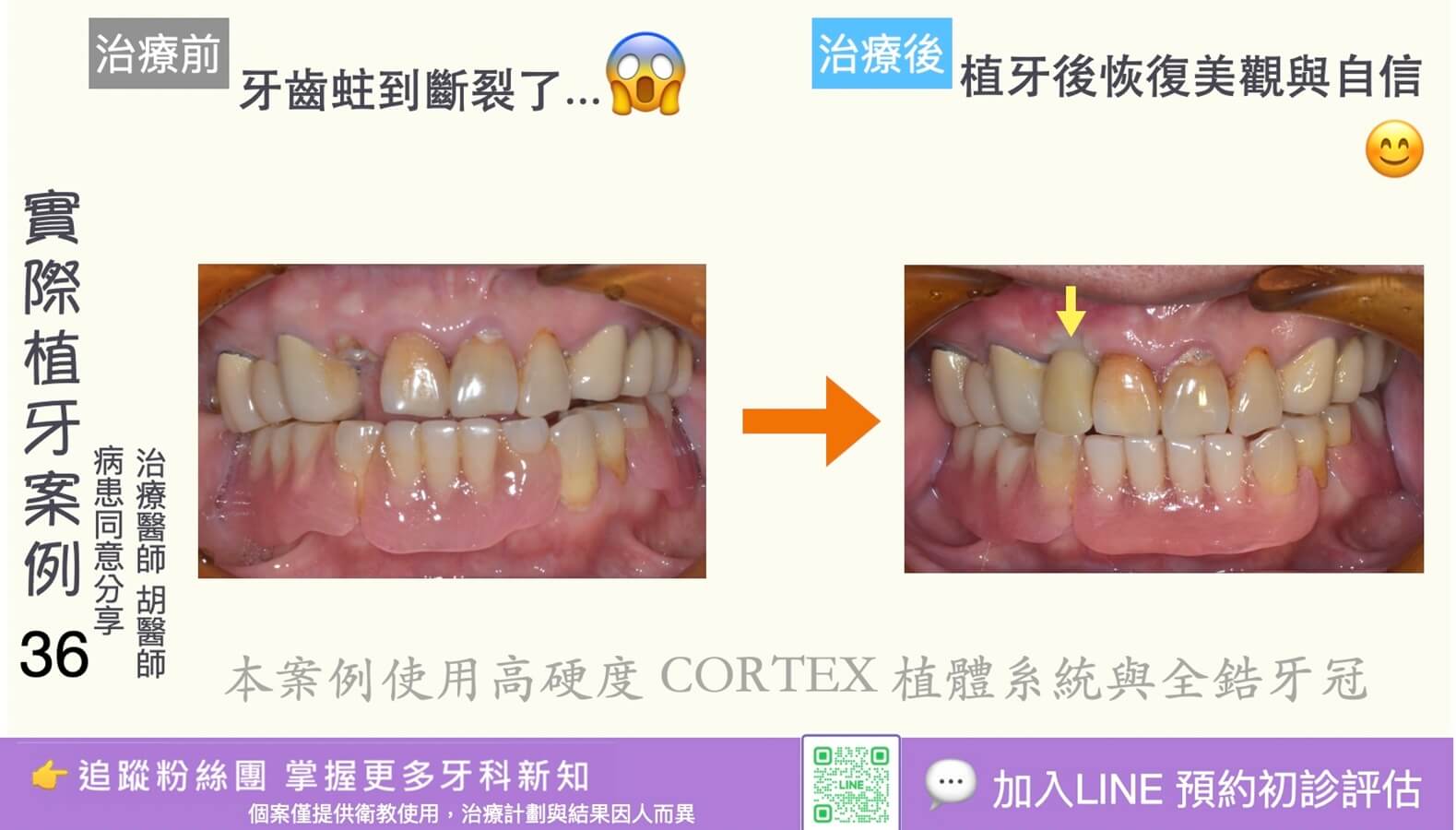 人工植牙治療實際案例成果36