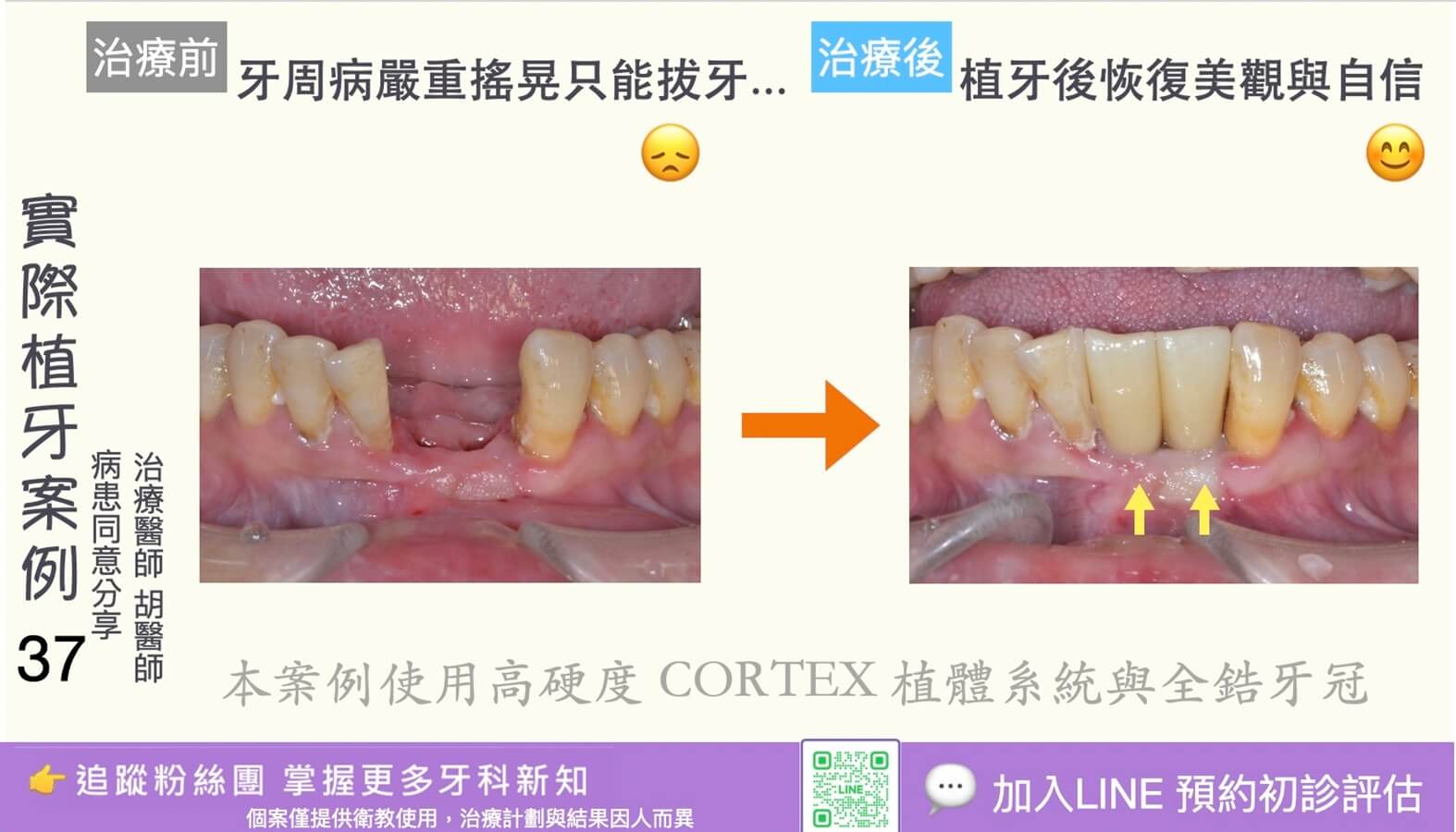 人工植牙治療實際案例成果37