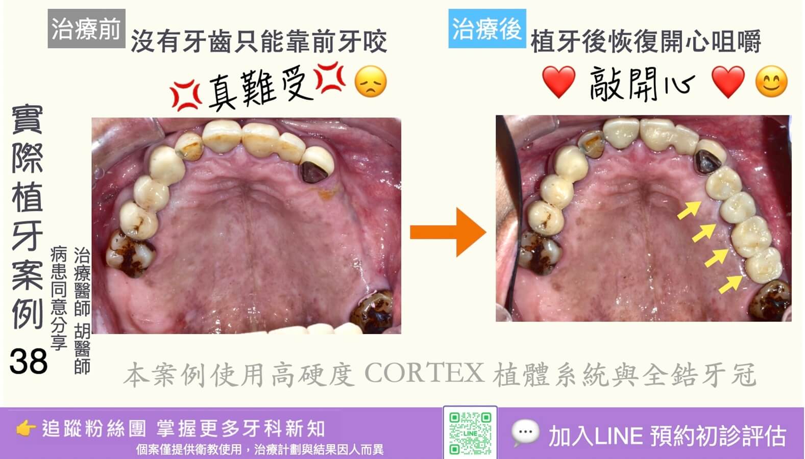 人工植牙治療實際案例成果38