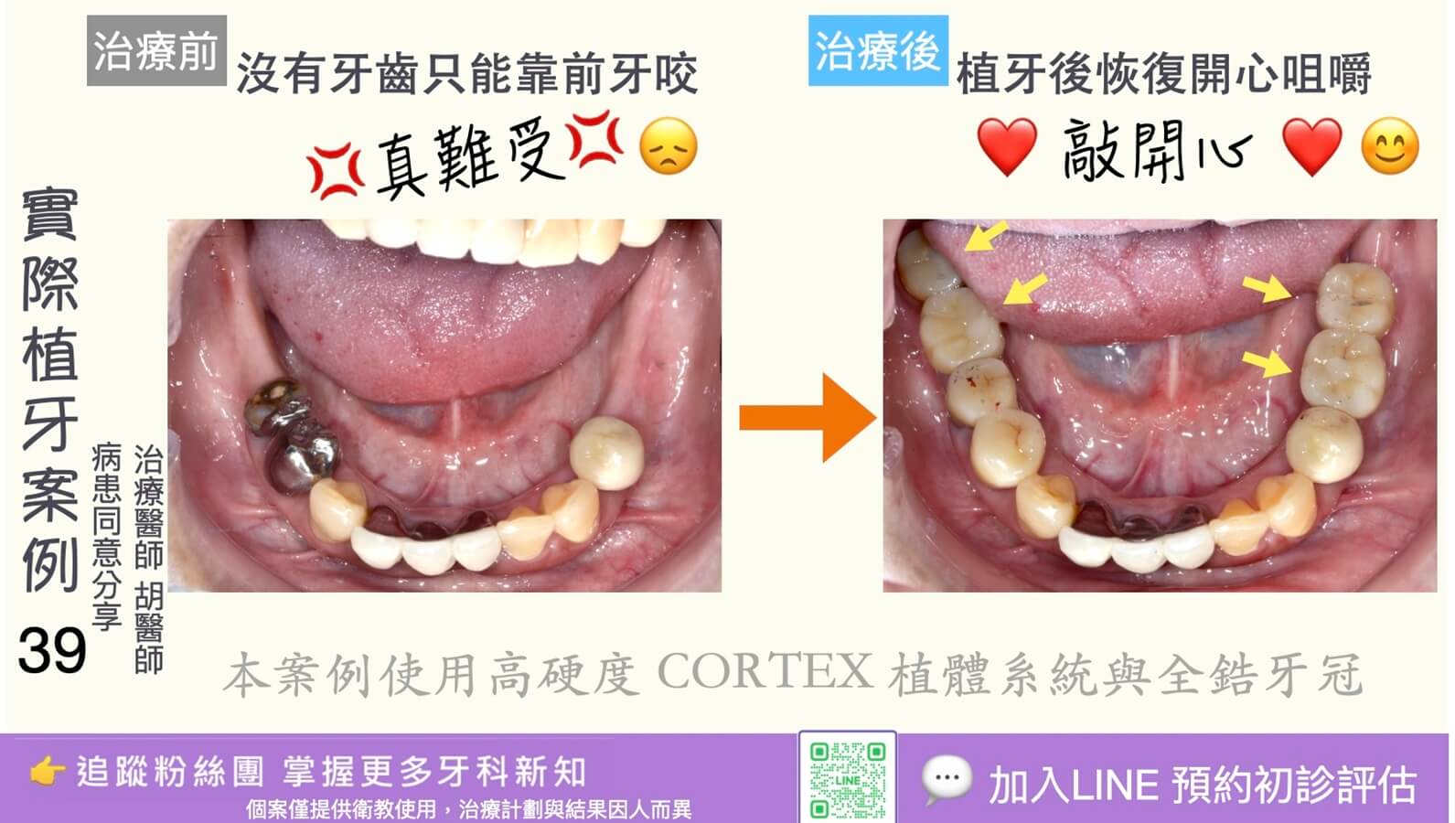 人工植牙治療實際案例成果39
