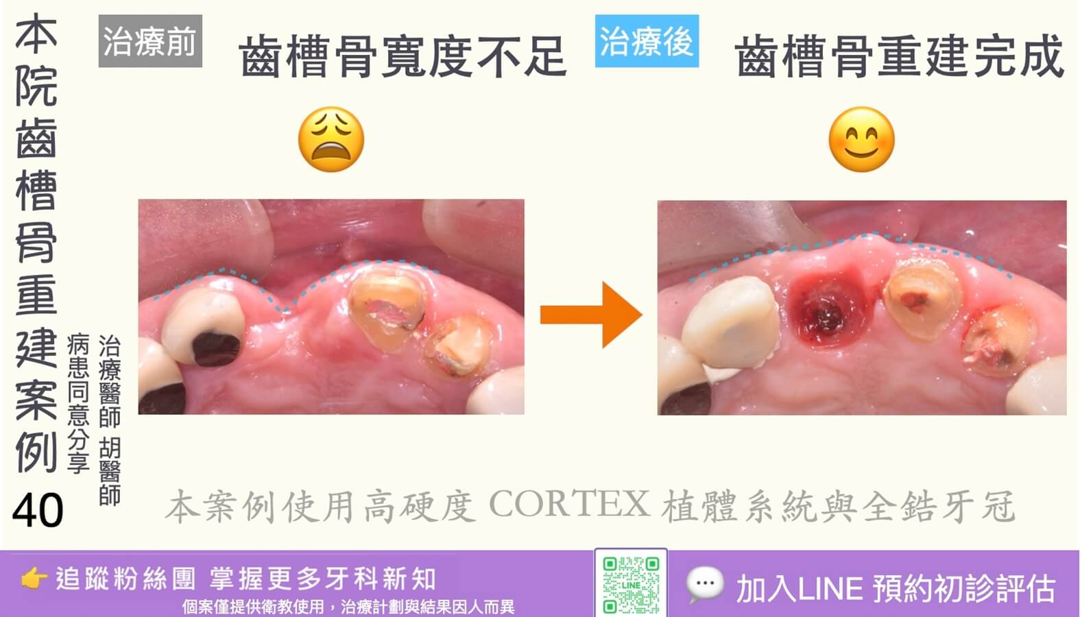 人工植牙治療實際案例成果40