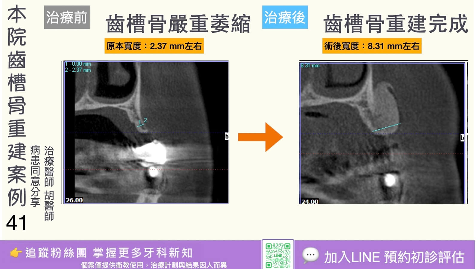 人工植牙治療實際案例成果41