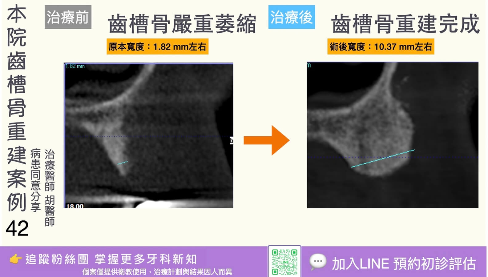 人工植牙治療實際案例成果42