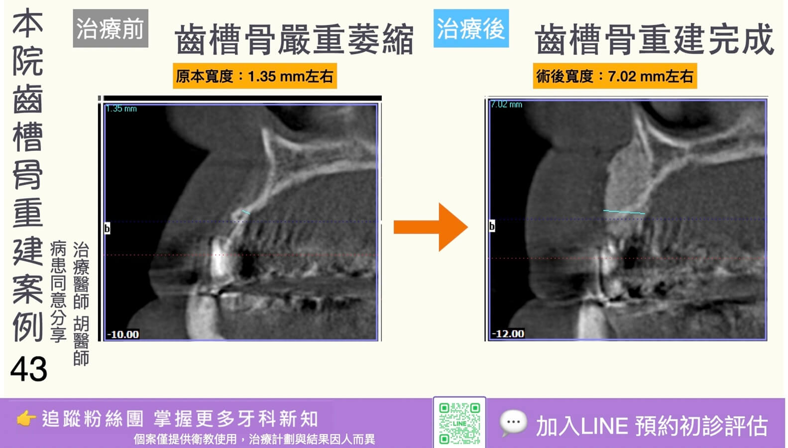 人工植牙治療實際案例成果43