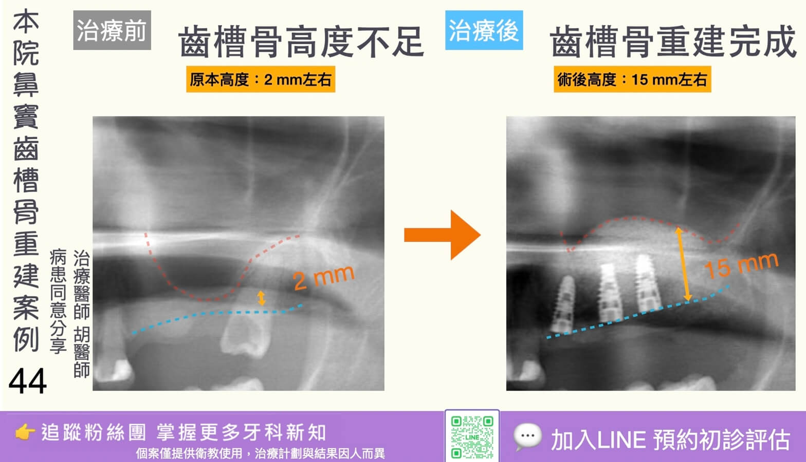 人工植牙治療實際案例成果44