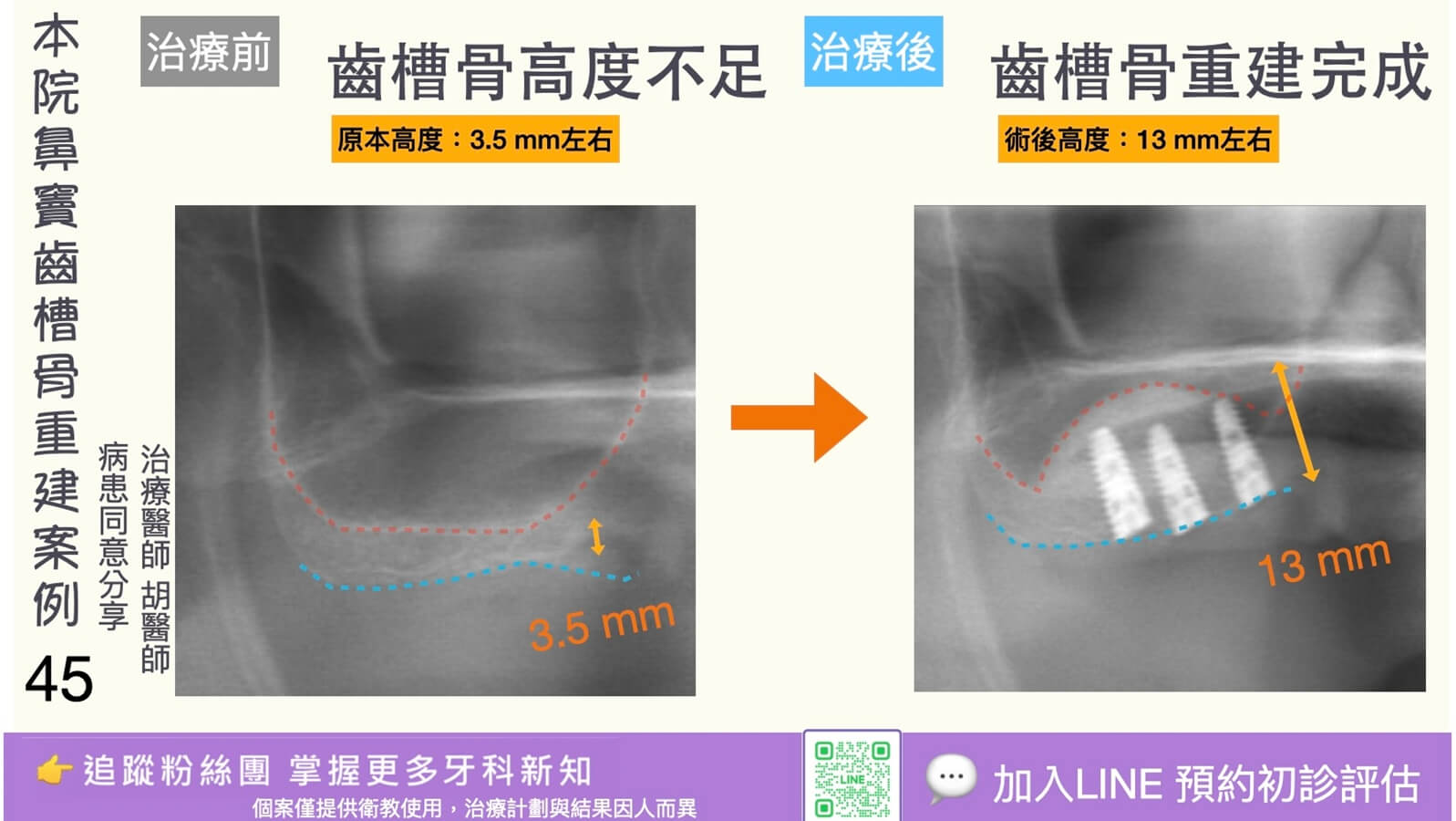 人工植牙治療實際案例成果45