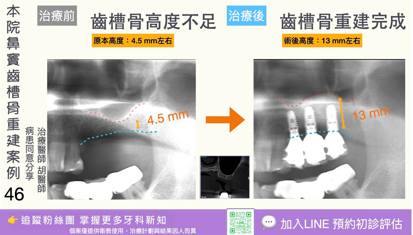 人工植牙治療實際案例成果46