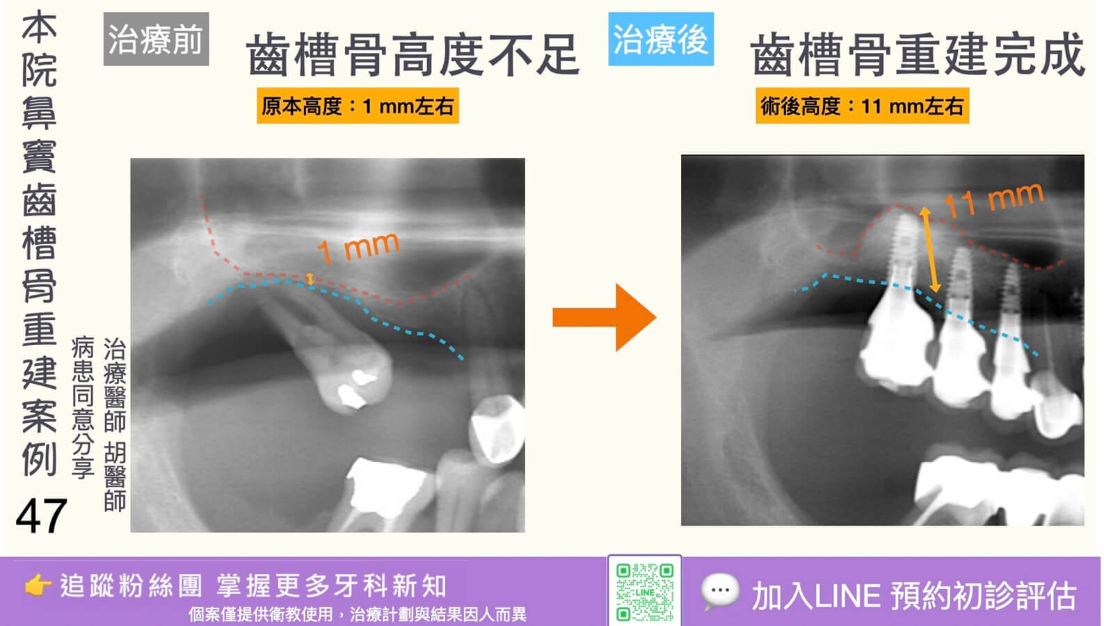 人工植牙治療實際案例成果47