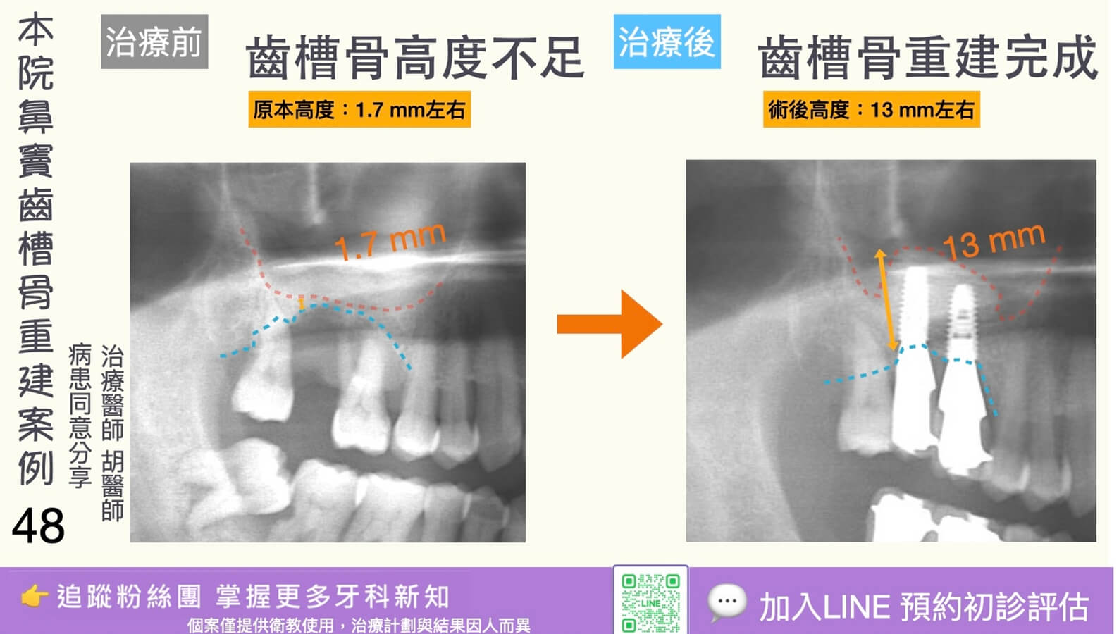 人工植牙治療實際案例成果48