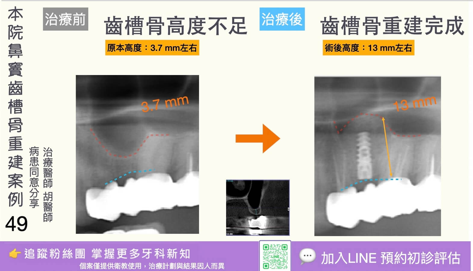 人工植牙治療實際案例成果49