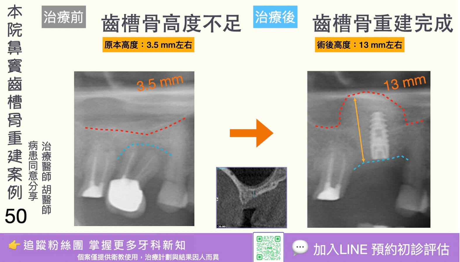 人工植牙治療實際案例成果50