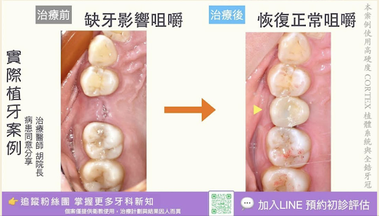 案例分享53｜什麼是仿生牙冠與全鋯冠和一般的瓷牙有什麼差別？