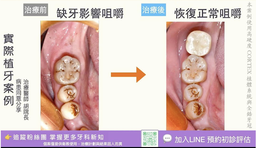案例分享54｜為什麼植牙的牙齒和自然牙長得不一樣呢？